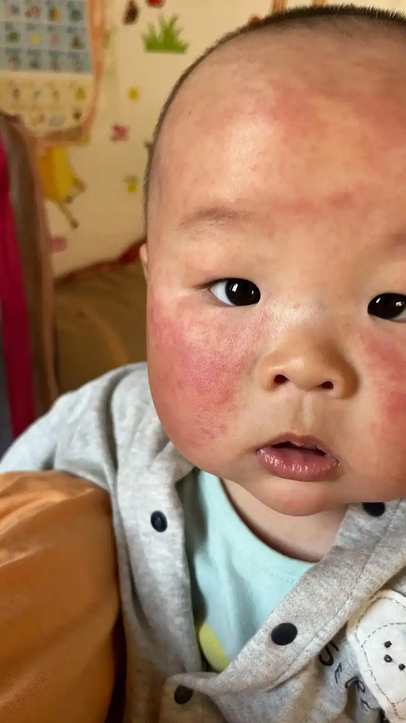 退烧后起了一身疹子.墩墩烧了两天终于#退烧了 昨天下午却冒出 - 抖音