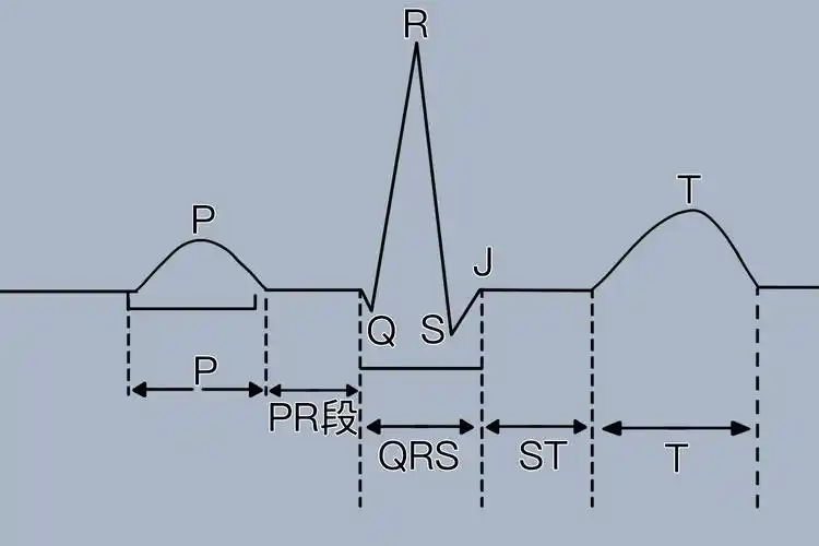 心电图qrs波群图