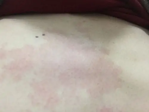 胸口上有一大块红色的斑,不痛不痒的,18岁的时候就