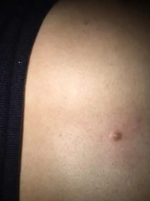 胸部正中央长了个肉疙瘩,开始是破皮的后来定甲扣掉了,后来就不知道