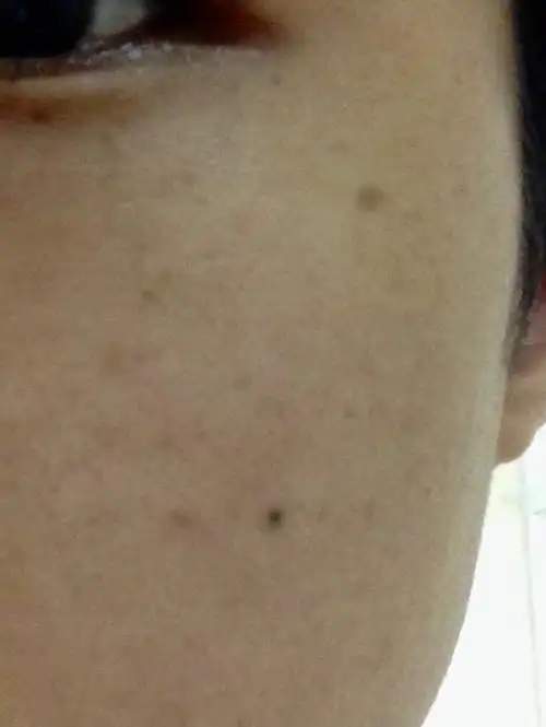 脸上的这些黑点黑块怎么去掉,谁有经济的的方法吗?