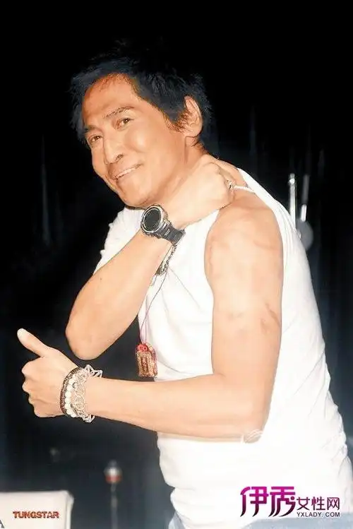 齐秦展示"惊悚"烧伤照