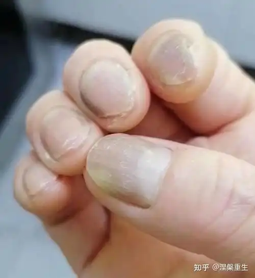 女生得了灰指甲怎么办