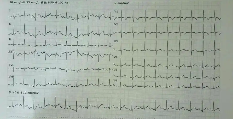 诊断:窦性心律怀疑右心室肥大