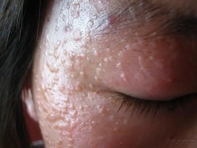 皮肤病小姑娘的扁平疣