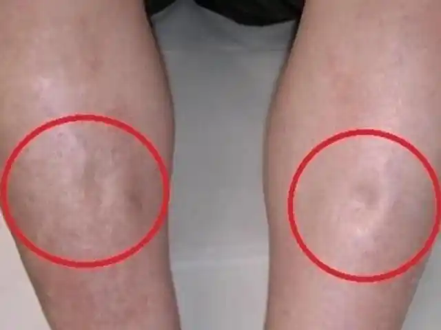 尿毒症大多是"拖"出来的,身体若有"3迹象",莫要耽搁,及时就医检查