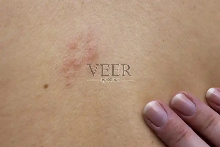 女人背上的带状疱疹照片摄影图片