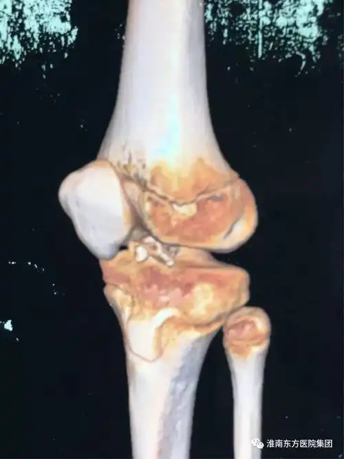 东方科普重塑膝望关节镜微创治疗儿童胫骨髁间棘撕脱性骨折