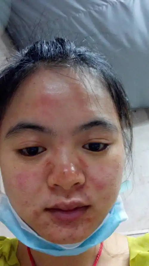 现在脸过敏成这样该怎么办