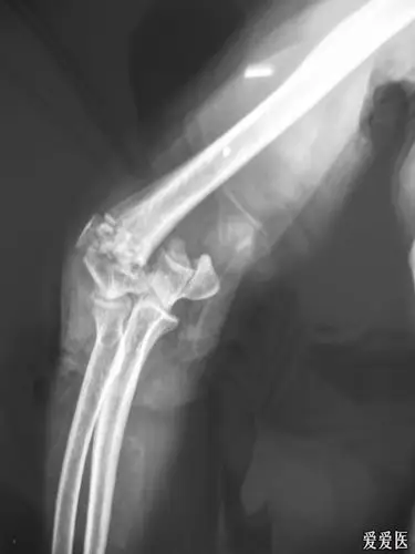 右肱骨髁间粉碎性骨折