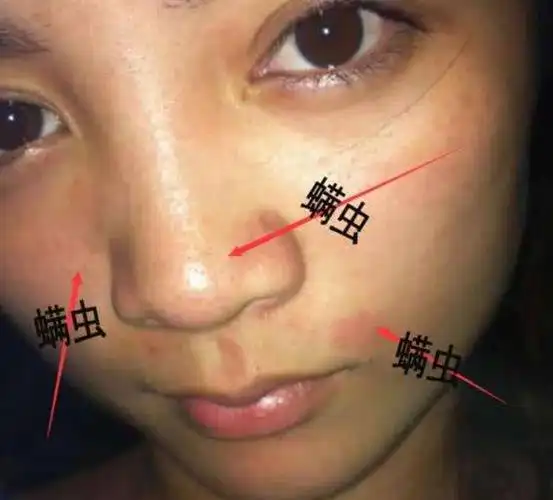 这种"虫子"见洞就钻,喜欢寄生在脸上,敢说人人都有,可别不信_网易订阅