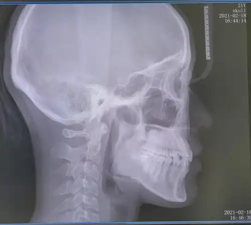 马泷齿科,第一次交三万,半年内交齐尾款,优惠完共48800不包骨钉来自