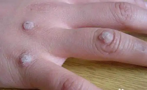 手上长了"瘊子"不用慌,分享3个简单的方法,轻松去除不再复发