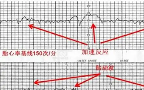 网传胎心监护可以看男女,看完这篇文章就知道准不准