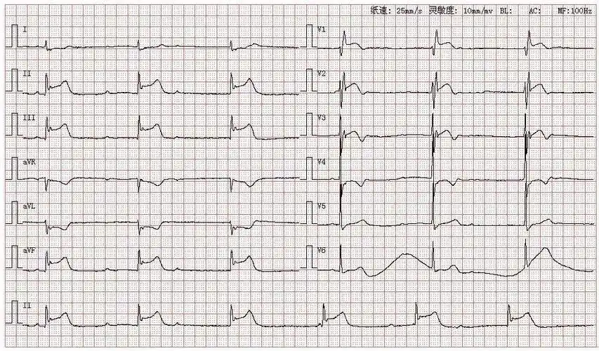 心电图库丨三度房室传导阻滞系列