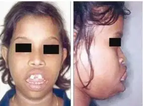 腺样体肥大-腺样体肥大怎么治-腺样体面容-腺样体肥大需要做手术吗-腺