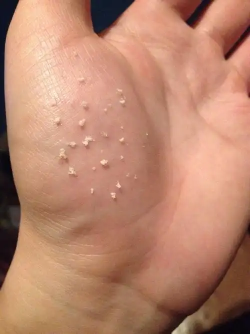 女性尿道口有白色米粒状(女性尿道口有白色米粒状 瘙痒 疼痛)