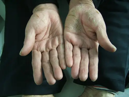 30年病史的-----手脚角化皲裂性湿疹,寻求好治法 - 皮肤性病 -丁香园