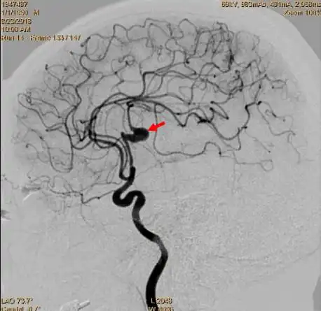 栗超跃教授颞浅动脉大脑中动脉m3搭桥术颅内蛇形动脉瘤切除并血管置换