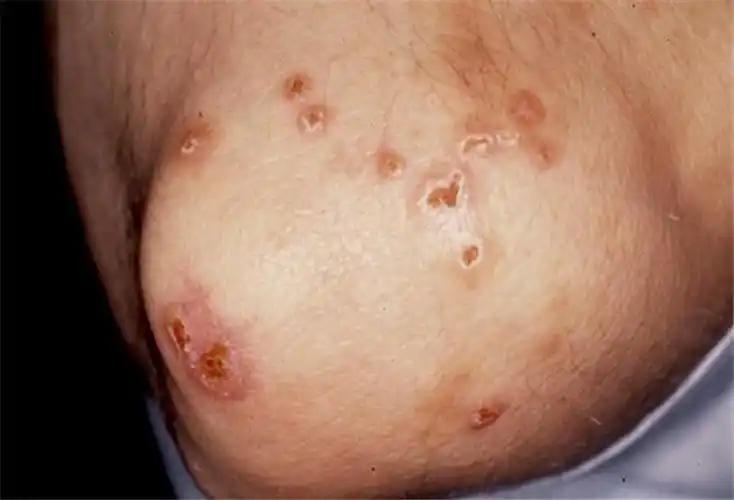 上唇化脓性肉芽肿图片