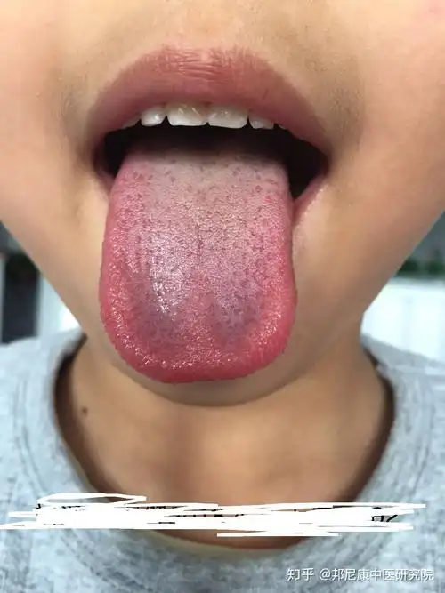 肺气虚宝宝的舌象
