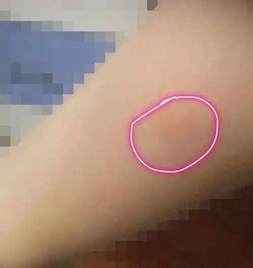 被一种不知名虫子咬了有快肿摸起来有刺痛像素不是很高.