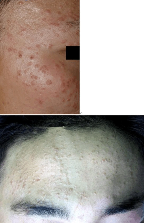 为什么要治疗:, 由于扁平疣病毒具有自身接种传染性,发现后应尽早将其