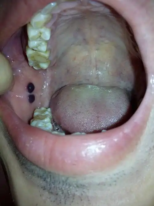 口腔内部,牙齿旁边的口腔上,长了两个红色血包.