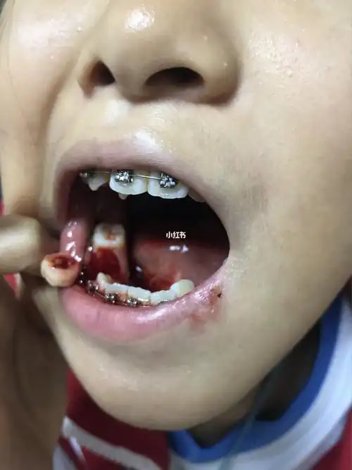 今天晚上大牙掉了,但是没把牙钉去掉,牙齿在里面可以前后转圈圈.