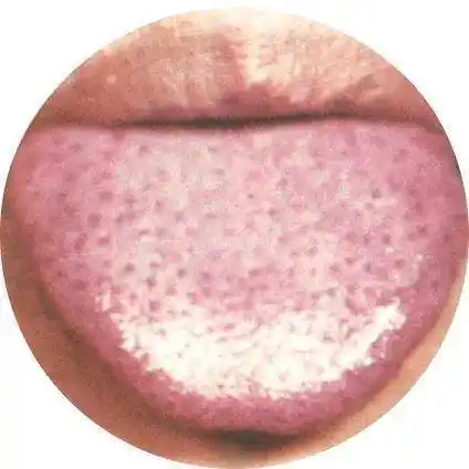 小儿常见草莓舌