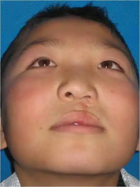 唇裂手术后畸形的修复