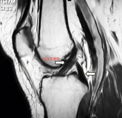 前交叉韧带|五张图复习一下 前交叉韧带(acl)起自股骨髁间窝的外侧面
