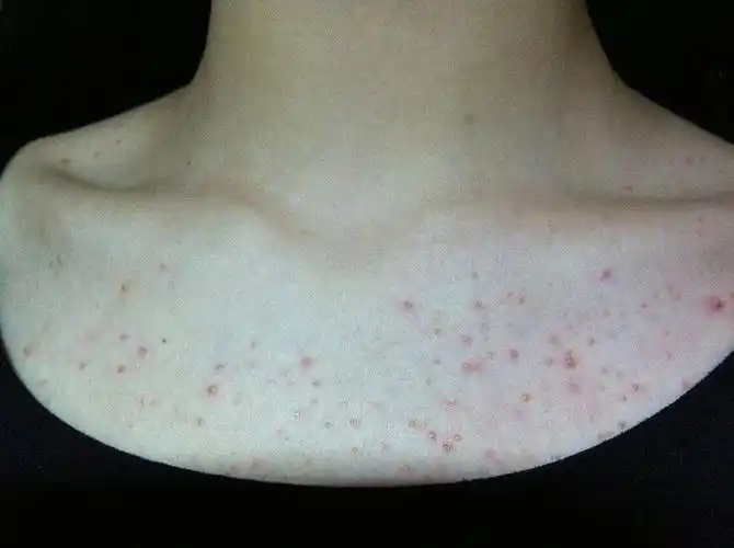 胸口长了一些小红点,怎么回事?