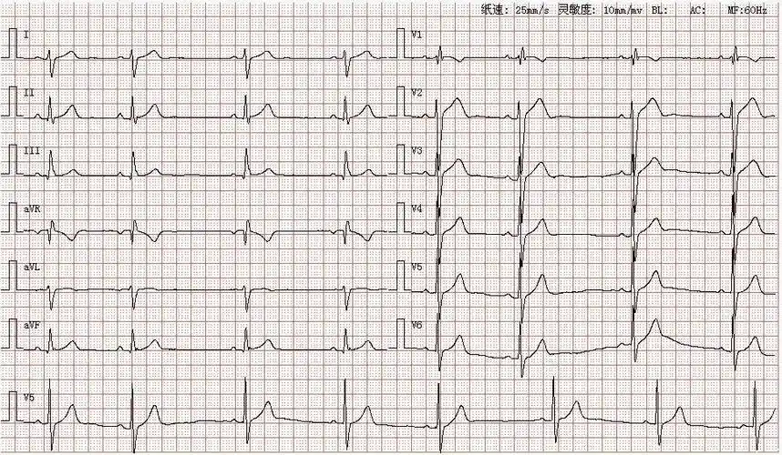 窦性心动过缓伴不齐不完全性右束支传导阻滞左后分支阻滞可能分析
