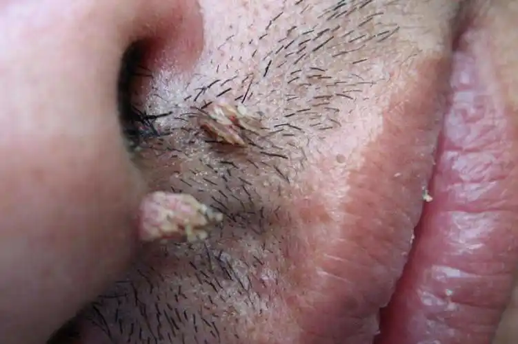 疣状体是什么图片_图文_文章_美咯_让您放心美!