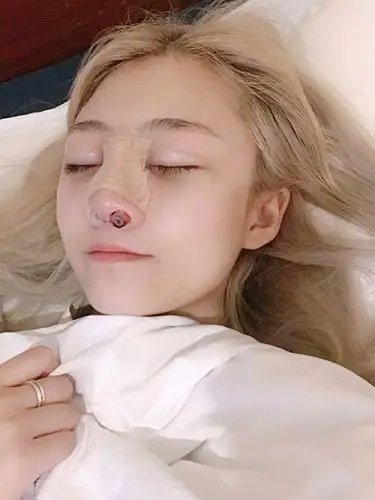 96现在是隆完鼻的第一天,我的鼻子里面还有引流管,因_圈子-新氧美容