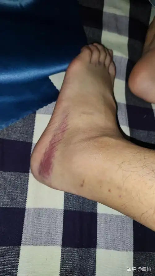 崴脚了一般要多久才能好真实记录贴