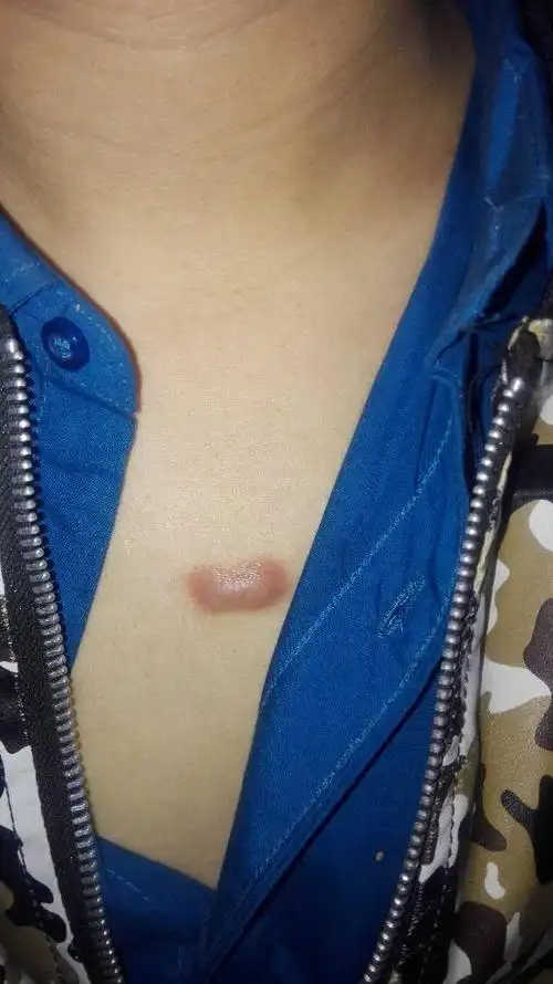 请大家帮我看看,这个疙瘩是什么?在我身上有两年的时间了.是不是粉瘤?