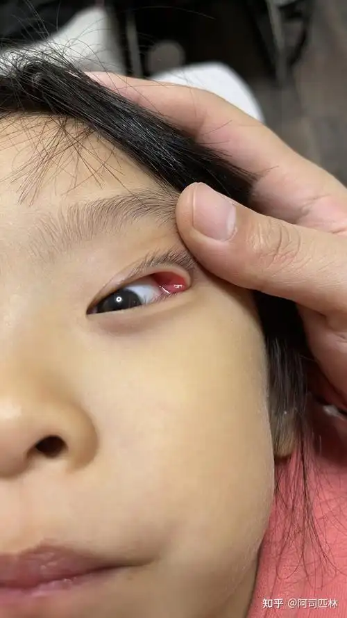 两天没怎么擦眼睛又有点肿了,眼珠还有点发红,百度了一下有说是霰粒肿