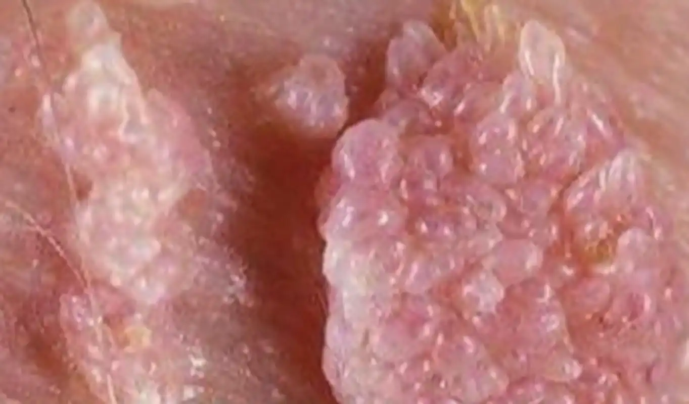 大家好,我是北京三甲医院曹梅医生,尖锐湿疣是一种