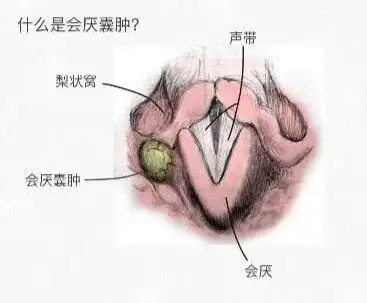 我咽部淋巴滤泡增生,会厌部有个大豆大的小囊肿,必须做手术吗?】