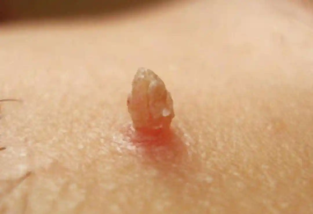 皮肤上的"小肉粒"是什么?医生道出答案,不妨对照自查