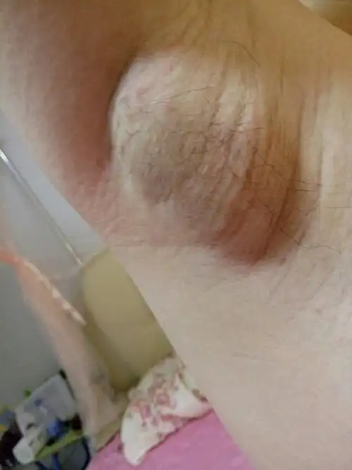 腋下变黑左右两边各长一团肉,鼓出来了,请问是什么原因.