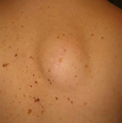 脂肪瘤怎么消除