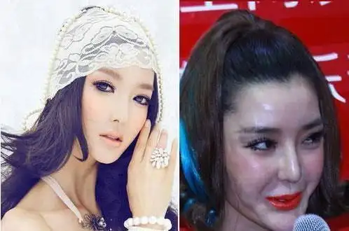 整容失败的女星有位为美貌却死在了整形手术台上