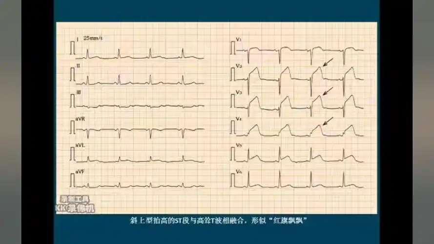心电图词汇解释系列(三):st段抬高型心肌梗死 67