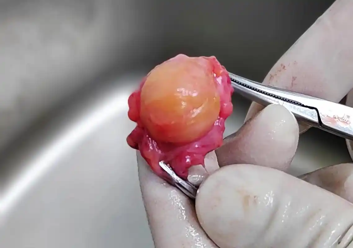 在头皮下 养了10多年 脂肪瘤 终于下定决心 切了!