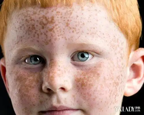 儿童脸上长雀斑怎么办 几大妙招让儿童肌肤瞬间白起来