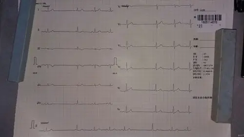 二度ii型窦房传导阻滞