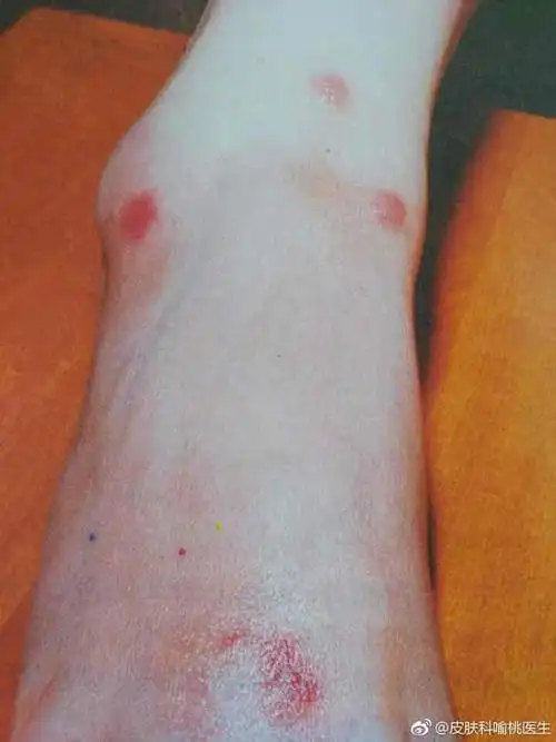 夏季常见皮肤病—丘疹性荨麻疹